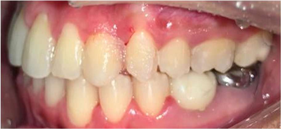 Impacted Canine - After